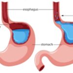 Gastroesophageal reflux disease