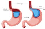 Gastroesophageal reflux disease (GERD)