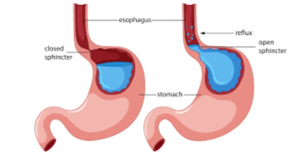 Gastroesophageal reflux disease (GERD)